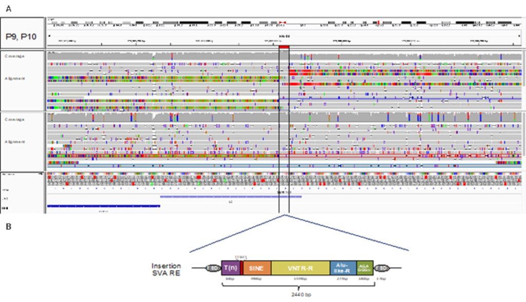 Figura 5. Visualización de la inserción de un elemento SVA en el intron 6 de SERPINC1. A.Representación de la visualización por IGV de los alineamientos de dos casos secuenciados por nanoporo. B. Esquema de la estructura del elemento SVA insertado.
