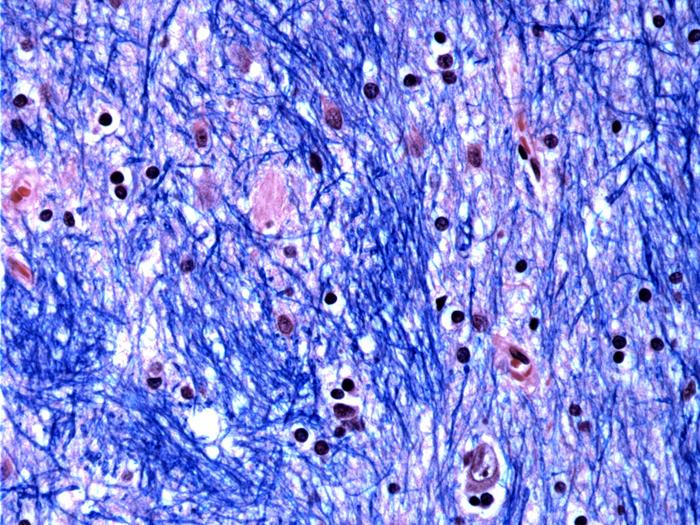 Tinción histológica del núcleo caudado de una persona con enfermedad de Huntington. Imagen: McLean Hospital’s Harvard Brain Tissue Resource Center / NIH NeuroBioBank.