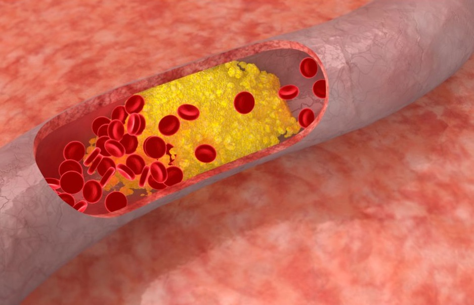 La estructura de una proteína aumenta riesgo cardiovascular en hipercolesterolemia familiar. 