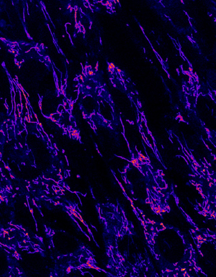 TANGO2 en celulas de paciente con TDD. Imagen: CRG.