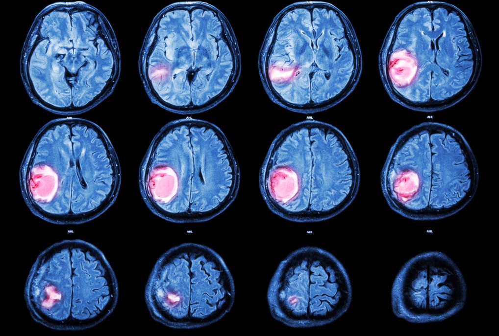 La secuenciación mediante nanoporos podría permitir clasificar tumores del sistema nervioso central de forma rápida