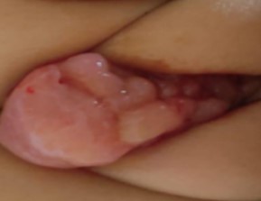 Figura 1. Rabdomiosarcoma embrionario: Masa irregular de consistencia blanda multilobulada a nivel genital con compromiso de labio mayor izquierdo y con ocupación del introito vaginal.