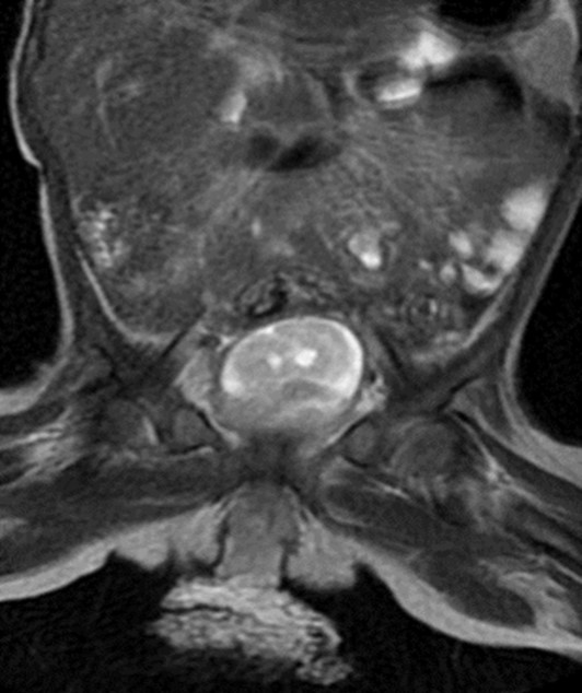 Figura 3. Resonancia magnética nuclear de abdomen y pelvis. Corte coronal donde se evidencia masa de bordes regulares de 3,9 x 3,4 x 6,5 cm, sin compromiso de otros órganos intrabdominales