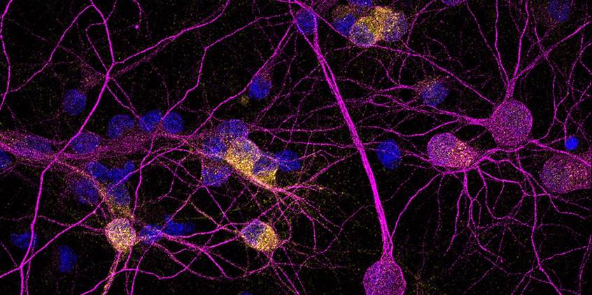 la proteína neuroprotectora PKD1 está reducida en las neuronas de pacientes con enfermedad de Huntington
