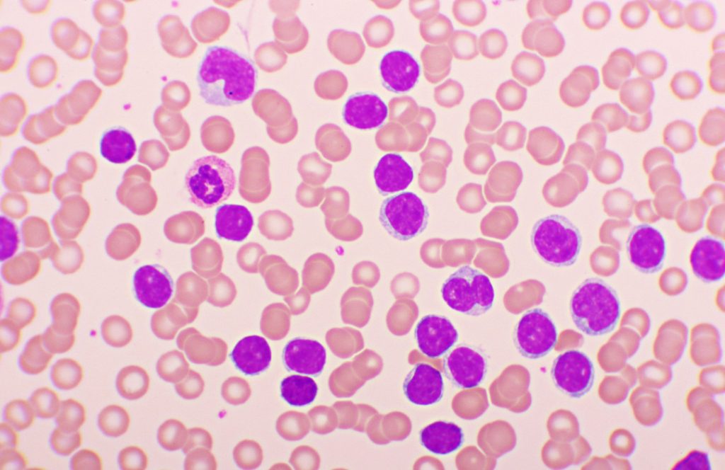 La nueva terapia para la leucemia linfoblástica de células T se basa en células CAR-T diseñadas para atacar células T tumorales y dejar intactas las células T normales