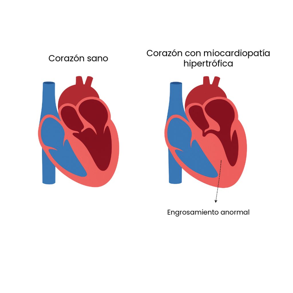 corazón con miocardiopatía hipertrófica