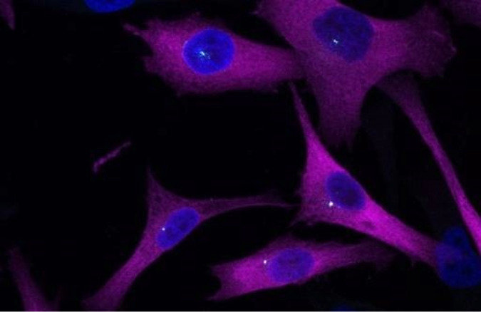 Células de melanoma. Un estudio ha identificado una proteína que, como un sistema GPS, es fundamental para guiar a las células tumorales de melanoma en su propagación por el organismo.Células de melanoma. Un estudio ha identificado una proteína que, como un sistema GPS, es fundamental para guiar a las células tumorales de melanoma en su propagación por el organismo.