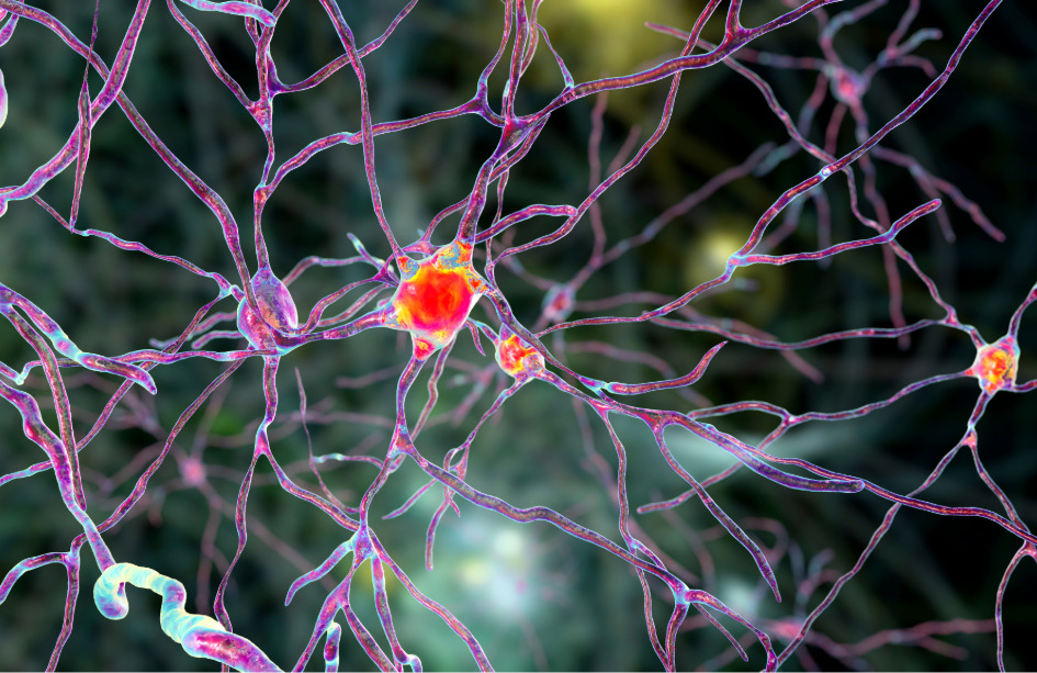 Las neuronas más afectadas en la enfermedad de Huntington se localizan en la región cerebral del estriado, donde se administra la terapia génica experimental. Imagen: Adobe Express.