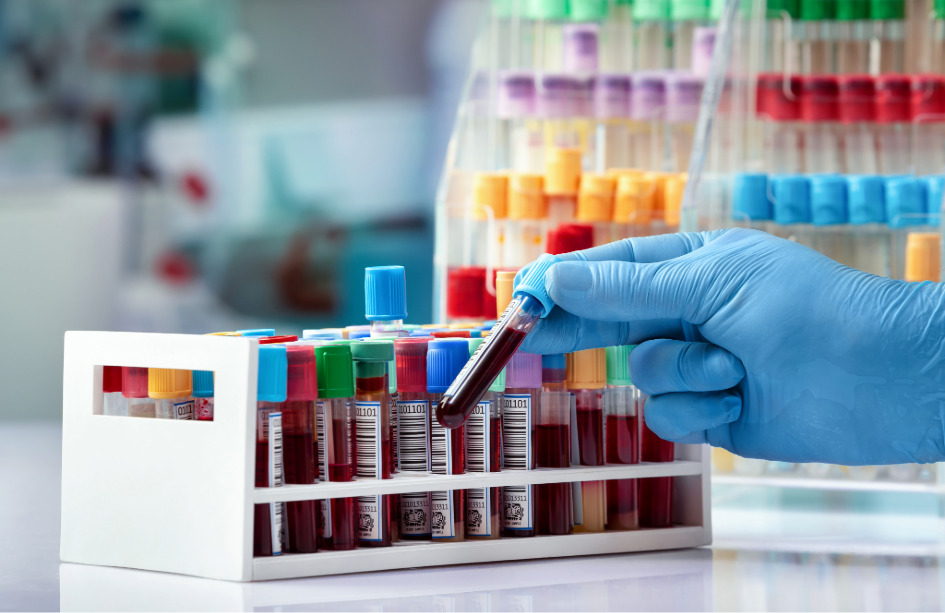 Un biomarcador en sangre podría detectar la enfermedad de alzheimer en sus etapas iniciales