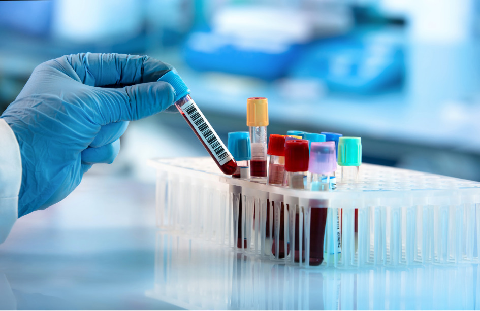 un análisis de sangre revela cambios tempranos en la enfermedad de Parkinson