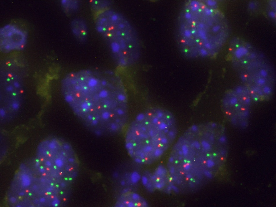 la proteína capicua está relacionada con la vulnerabildiad de algunos tratamientos para el cancer pulmón