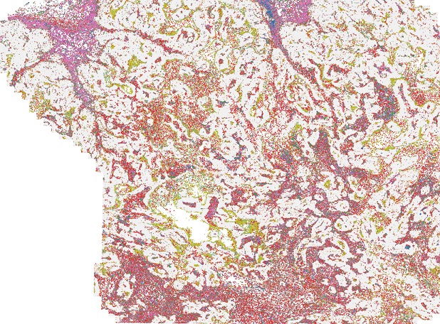 Un nuevo tipo de moléculas despiertan la inmunidad antitumoral del paciente bloqueando el escudo del tumor formado por ciertos macrófagos y favoreciendo el ataque de otras células a las células tumorales. En la imagen se muestra el mapeo de la arquitectura inmunitaria espacial en el tejido mamario humano afectado por cáncer