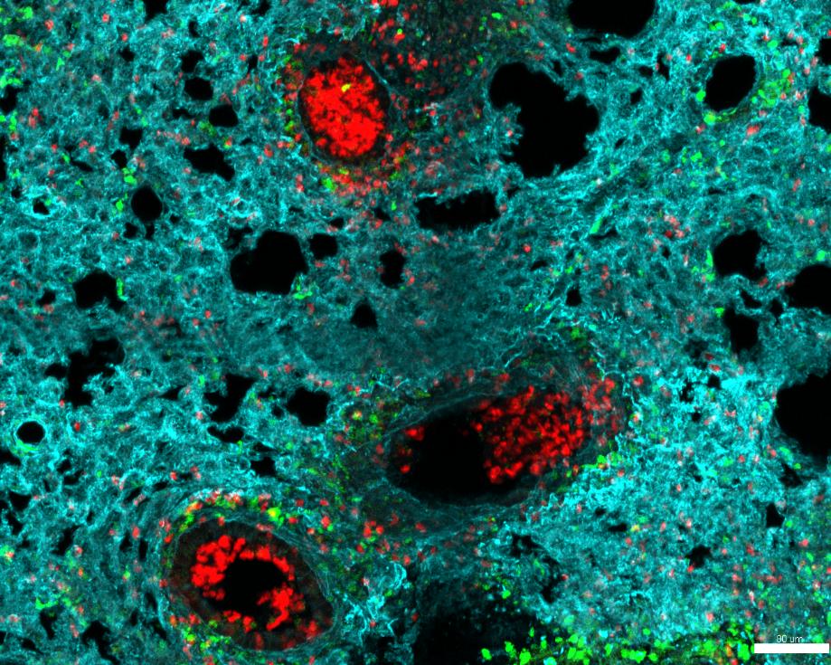 Neutrófilos (rojo) se acumulan en los alveolos de un pulmón infectado con gripe Iván Ballesteros CNIC.