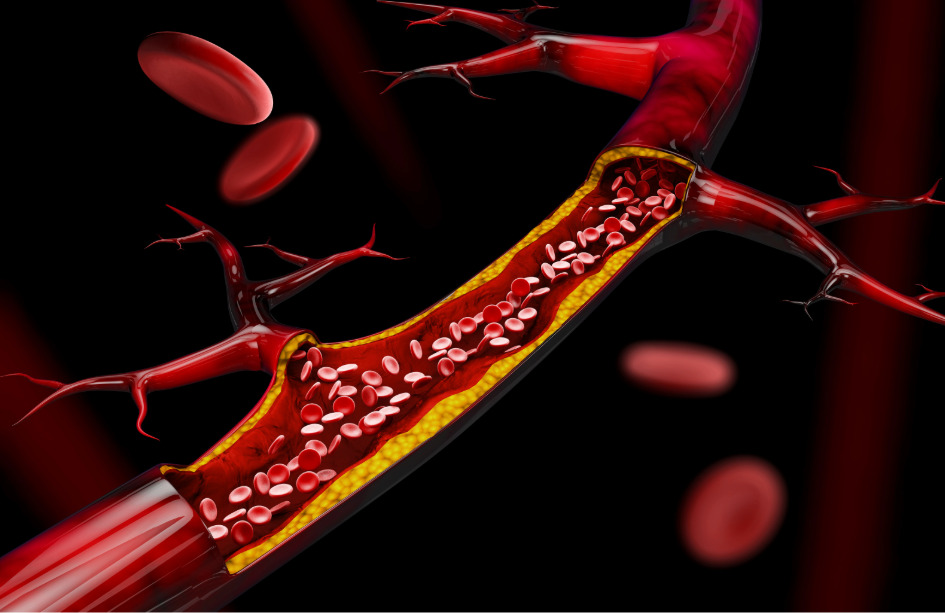 La aterosclerosis es una enfermedad crónica caracterizada por la acumulación de colesterol y otras sustancias en las arterias.