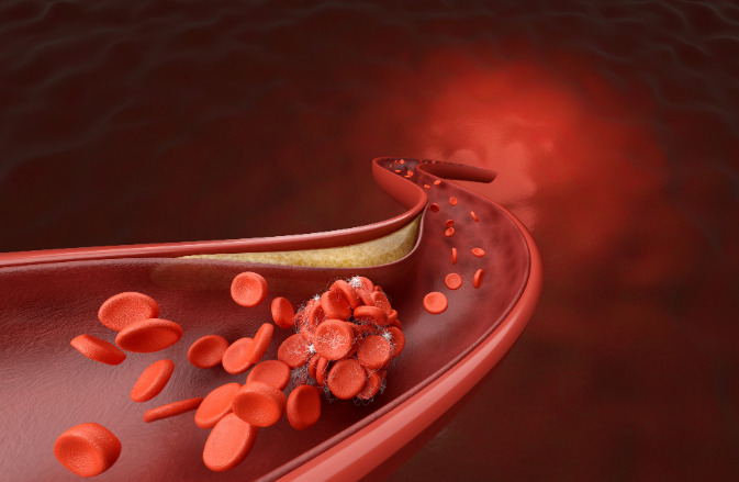 Un reciente artículo resume los tipos de predisposición genética a la enfermedad coronaria y su impacto en prevención, diagnóstico y tratamiento.