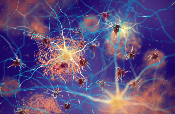 Una nueva estrategia terapéutica ha evaluado el potencial de las células CAR-T para atacar las placas de proteína beta amiloide en tejido nervioso que comprometen en funcionamiento de las neuronas y que caracterizan la enfermedad de Alzheimer