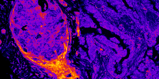 El cáncer de mama (izquierda) presenta niveles nucleares más altos de enzimas productoras de energía que el cáncer de pulmón (derecha). Crédito: Alberto Coll Manzano/Centro de Regulación Genómica