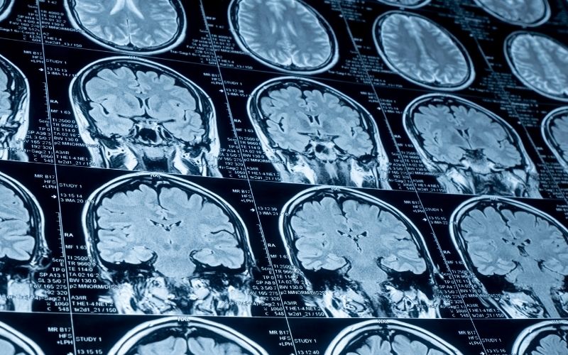 El líquido cefalorraquídeo puede ofrecer información sobre la evolución de tumores cerebrales.