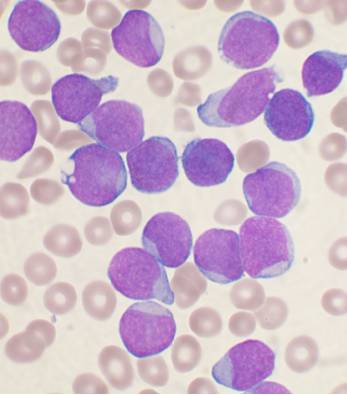 Células de leucemia linfoblástica aguda. 