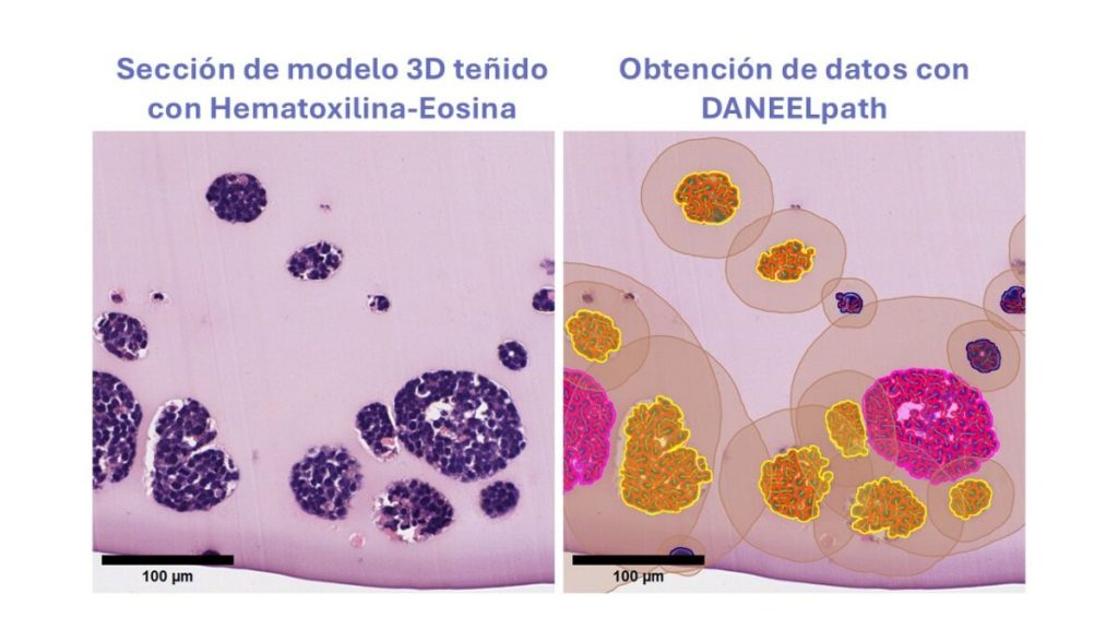 Ejemplo de cómo funciona DANEELpath, herramienta basada en IA para estudiar modelos 3D del tumores infantiles como el neuroblastoma