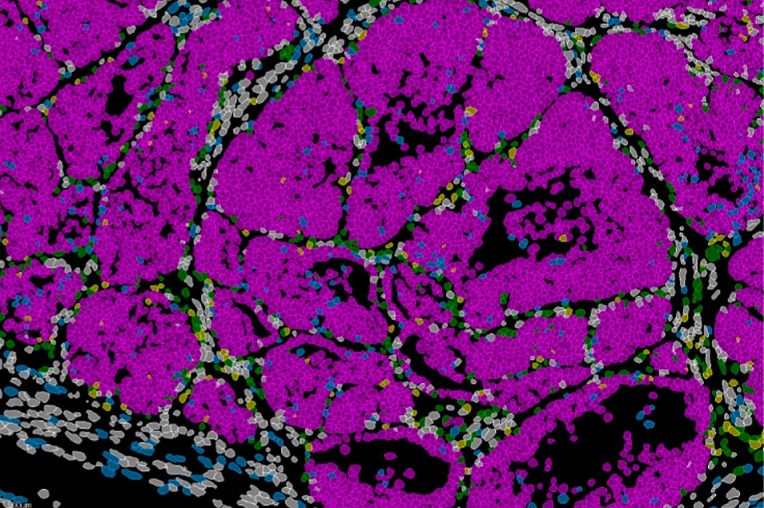 Ciertas células del tumor de cáncer de mama adoptan un estado de capacidad de metástasis coordinadas por el gen Prrx1.