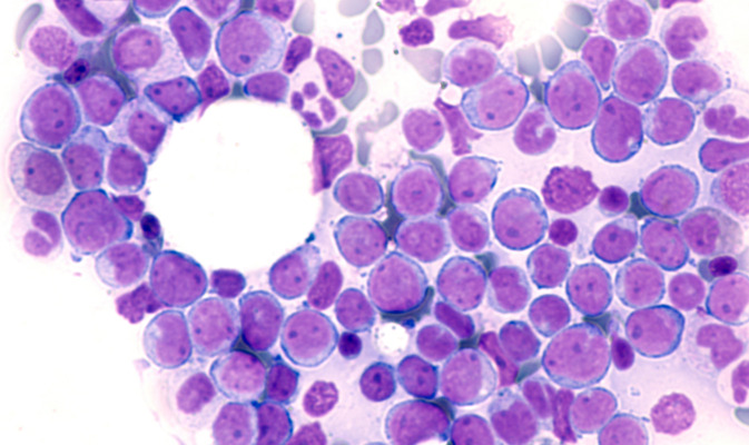En algunos pacientes la leucemia mielomonocítica crónica puede evolucionar a leucemia mieloide aguda.