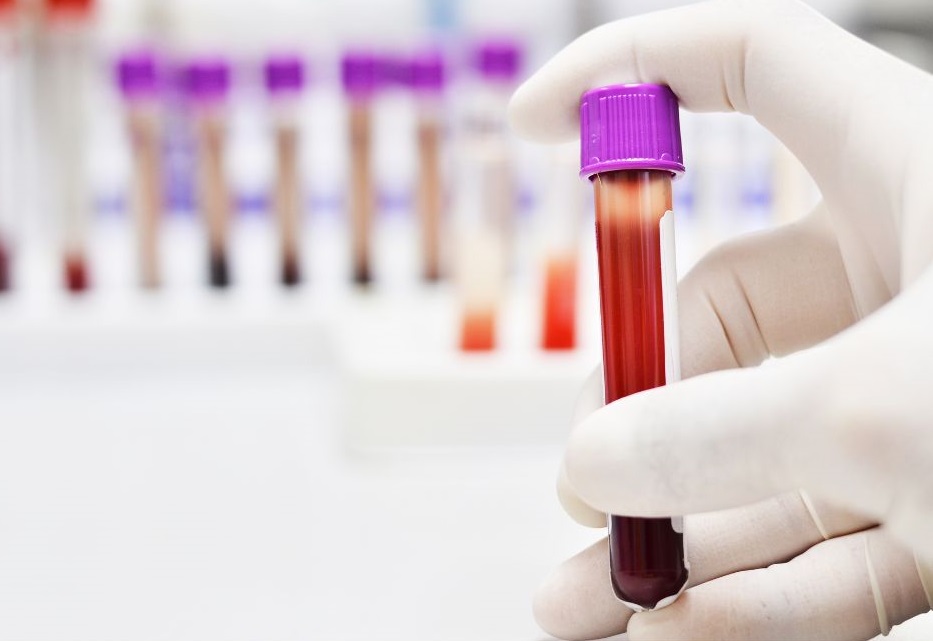 Desarrollan un prototipo de test diagnóstico para detectar el cáncer de páncreas en minutos con una muestra de sangre