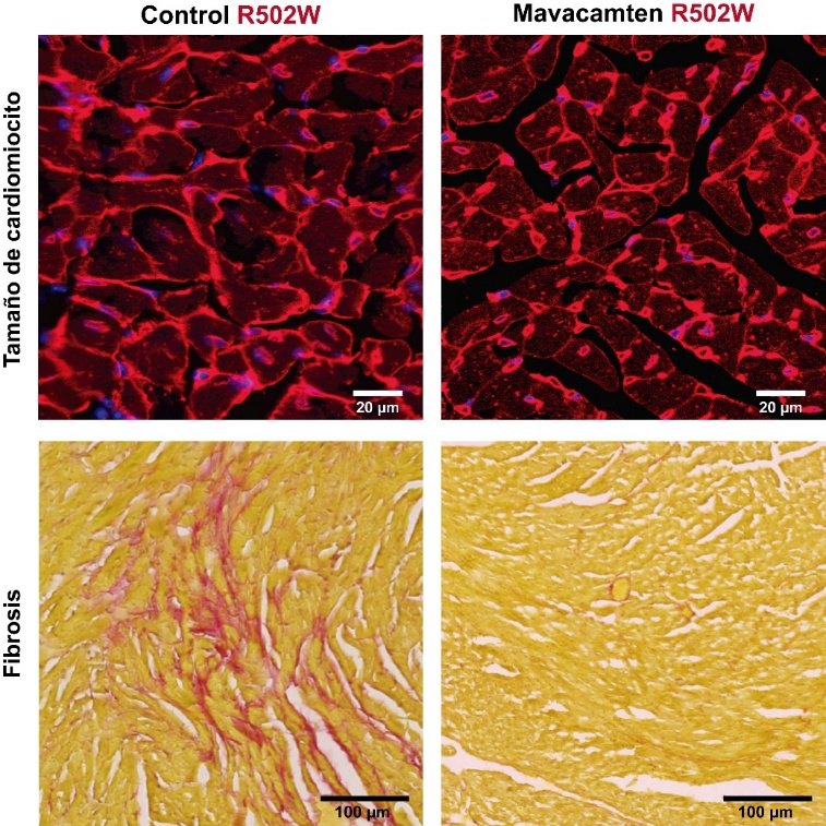 Figura: Imágenes de microscopía del corazón de ratones R502W sin tratar (izquierda) y tratados con mavacamten (derecha). La fila superior muestra el tamaño de las células cardíacas (cardiomiocitos), aumentado en el animal enfermo y reducido tras el tratamiento. La fila inferior muestra la fibrosis, acumulación de colágeno en el músculo cardíaco, abundante en animales R502W sin tratar y reducida tras el tratamiento con mavacamten.