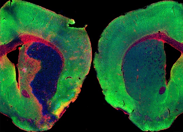 Izquierda, cerebro de ratón después de un ictus, con una extensa pérdida de neuronas y gran respuesta inflamatoria. A la derecha cerebro de un ratón sano. Los niveles de cortistatina se reducen después de un ictus. Imagen: J. Castillo CHUV .
