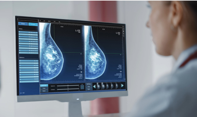 Ensayos prospectivos permitirán comprobar si la cabergolina puede prevenir el cáncer de mama