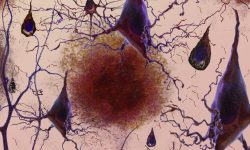 Pérdida de conexiones neriviosas entre las células de los pacientes con Alzhéimer. Imagen: Instituto Nacional de Envejecimiento (NIA), EEUU.