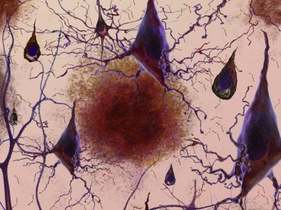 Pérdida de conexiones neriviosas entre las células de los pacientes con Alzhéimer. Imagen: Instituto Nacional de Envejecimiento (NIA), EEUU.