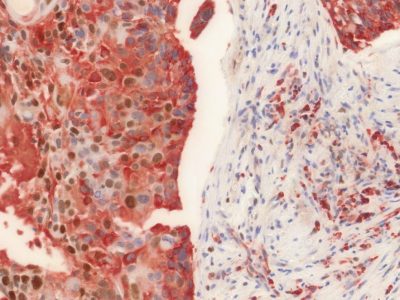 Biopsia de un tumor de cabeza y cuello en el que se observa la expresión de p21 (marrón) y de la proteína S6 fosforilada (rojo). La fosforilación de S6 depende indirectamente de mTOR por lo que se utiliza como indicador de la actividad de este enzima. Imagen cortesía de Susana Llanos, CNIO.