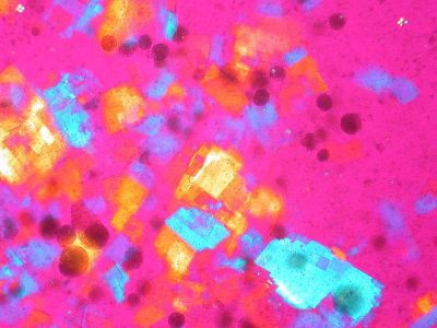 Cristales de colesterol. By Ed Uthman, MD, pathologist, Houston, Texas, USA (Own work) [CC-BY-3.0 (http://creativecommons.org/licenses/by/3.0)].