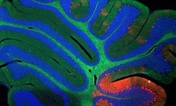 Imagen del cerebelo de un ratón con enfermedad Niemann Pick, donde se aprecia la degeneración de las neuronas (abajo derecha). Imagen: NICHD, CC BY 2.0 https://creativecommons.org/licenses/by/2.0/ ).