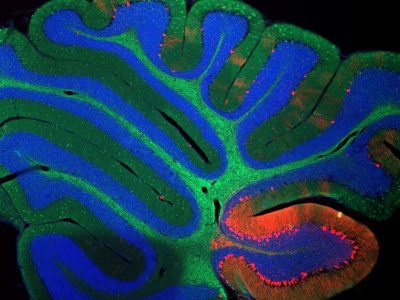 Imagen del cerebelo de un ratón con enfermedad Niemann Pick, donde se aprecia la degeneración de las neuronas (abajo derecha). Imagen: NICHD, CC BY 2.0 https://creativecommons.org/licenses/by/2.0/ ).
