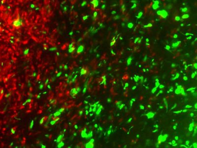 Las células tumorales modificadas mediante CRISPR para ser resistentes al tratamiento y administrarlo en el tumor (en verde) son capaces de rastrear células del tumor cerebral primario (en rojo). Imagen: Laboratorio de Khalid Shah.