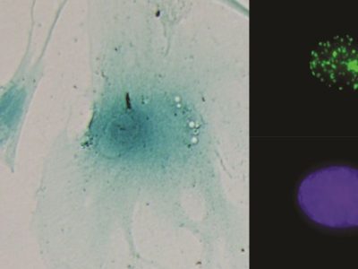 Imágenes de dos células senescentes (izquierda). A la derecha un núcleo celular mostrando foco de daño al ADN (arriba) y su control (abajo).