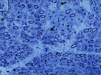 Biopsia de un nervio sensorial de un participante en el ensayo de terapia génica para la neuropatía axonal gigante (las flechas indican axones gigantes; grupo de nervios en regeneración en la parte superior izquierda). Imagen: Laboratorio Bonnemann/NINDS.