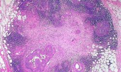 Adenocarcinoma de colón metastásico en nódulo linfático. Imagen: Ed Uthman (CC BY 2.0 http://creativecommons.org/licenses/by/2.0).