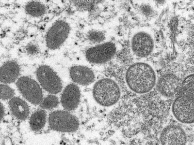 Viriones de virus de la viruela del mono en una muestra clínica de piel humana obtenida en un brote de 2003 y observada mediante microscopía electrónica. A la izquierda se observan partículas víricas maduras y a la derecha viriones inmaduros. Imagen:  Cynthia S. Goldsmith, Russell Regnery, Center for Disease Control.