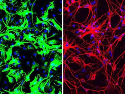 A la izquierda astrocitos de ratón antes de la reprogramación, a la derecha neuronas inducidas a partir de los astrocitos tras el tratamiento con oligocleótidos antisentido. UC San Diego Health Sciences.
