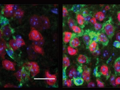 A la derecha neuronas de un ratón modelo para la enfermedad de Huntington mostrando más proteína quinasa R (en verde), que las neuronas de la izquierda, que proceden de un ratón sano. Imagen: Hyeseung Lee/MIT Picower Institute.