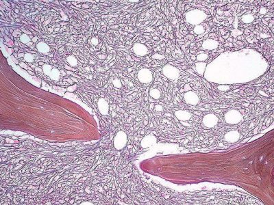 Aumento de reticulina en la médula  en un desorden mieloproliferativo. Imagen: Ed Uthman (https://creativecommons.org/licenses/by/2.0/)