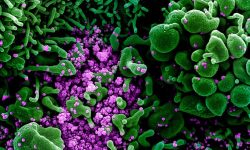 Célula apoptótica (verde) fuertemente infectada por coronavirus SARS-CoV-2. Imagen: NIAID (CC BY 2.0 https://creativecommons.org/licenses/by/2.0/).