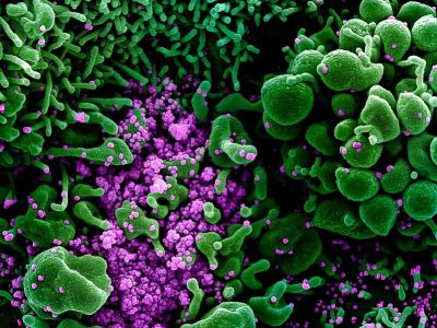 Célula apoptótica (verde) fuertemente infectada por coronavirus SARS-CoV-2. Imagen: NIAID (CC BY 2.0 https://creativecommons.org/licenses/by/2.0/).
