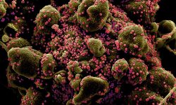 Célula aislada de un paciente fuertemente infectada por SARS-CoV-2. Imagen: National Institute of Allergy and Infectious Diseases, NIH.