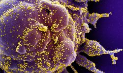 Célula apoptótica (morado) infectada por partículas víricas de SARS-CoV-2. Imagen: National Institute of Allergy and Infectious Diseases, NIH.