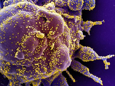 Célula apoptótica (morado) infectada por partículas víricas de SARS-CoV-2. Imagen: National Institute of Allergy and Infectious Diseases, NIH.
