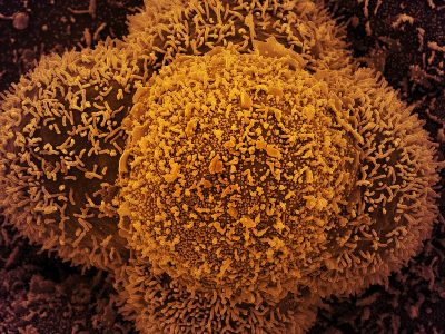Células CCL-81 (células Vero utilizadas en investigación) fuertemente infectadas con partículas del virus SARS-CoV-2. Imagen: 
NIAID / Flickr, CC BY 2.0 (https://creativecommons.org/licenses/by/2.0/).
